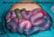 acute intestinal ischemia