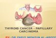 Thyroid cancer /  papillary carcinoma