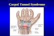 Carpal Tunnel Syndrome.ppt