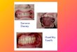 Periodontal/Gum Disease Periodontal/gum diseases are serious infections that, left untreated, can lead to tooth lossPeriodontal/gum diseases are serious