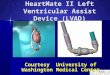 HeartMate II Left Ventricular Assist Device (LVAD) Courtesy University of Washington Medical Center