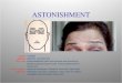 ASTONISHMENT Muscle: Frontalis Emotion: Attention, Astonishment Skin Type: Deep established lines with keratosis and diminishing elasticity approaching