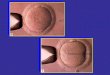zona pellucida citoplasma membrana vitellina spazio vitellino 1. ICSI 2. SUZI 3. PZD 1. ICSI= intracytoplasmic sperm injection 2. SUZI= sub-zonal injection