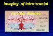Presentation1.pptx, intra cranial vascular malformation