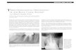 THREE-DIMENSIONAL OBTURATION OF THE ROOT CANAL SYSTEM* by Clifford J.Ruddle,D.D.S