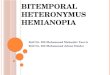 Bitemporal Heteronymous Hemianopia