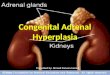 Congenital adrenal hyperplasia