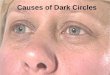 Top 5 Causes Of Dark Circles