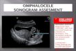 fetal imaging omphalocele
