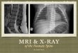 MRI and X-Ray of the Neonate Spine