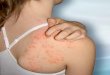 What To Do About Hives
