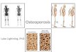 Osteoporosis Therapy Overview
