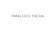 Paralisis Facial Periferica