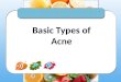 The science of acne in layman’s term