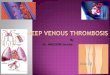 Deep venous thrombosis