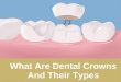 What are dental crowns and their types