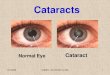 D l cataract-information_jvc