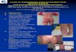 EWMA 2014 - EP432 CAUSES OF HYPERTROPHIC SCARS IN CHILDREN WITH EFFECTS OF BURNS AND WAYS TO PREVENT THEIR DEVELOPMENT
