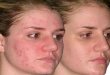How To Treat Acne Naturally And Effectively?