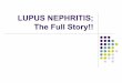 Lupus nephritis by dr saddique 2