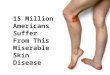 15 million americans suffer from this miserable skin disease