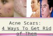 Acne Scars:  4 Ways To Get Rid of Them