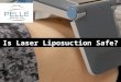 Is Laser Liposuction Safe? or Alternatives?
