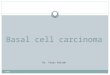Basal cell carcnoma