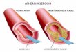 Arteriosclerosis - The cause of many Chronic Disease Complication