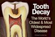 Denatal caries - Tooth decay