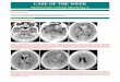 Case record......Primary subependymal CNS lymphoma (MRI approach)