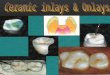 Ceramic Inlays & Onlays