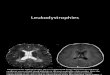 Leukodystrophies Imaging