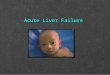 Acute liver failure in pediatric