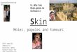 Skin Moles, papules and tumours Goadsby&Rutherford 2015 Q: Why has Nick gone to Oxford??? With special thanks to Nicholas James Durbin Gould for the presentation