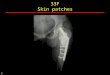 33F Skin patches 3. 2 1 McCune Albright 13M Bone Age - ESRD 2