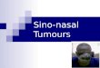 Sino-nasal Tumours. Tumors of the nasal cavity proper are approximately evenly divided between benign and malignant neoplasia, with inverting papilloma