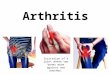 Arthritis Irritation of a joint where two bones move against one another