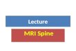 Lecture MRI Spine. Bone marrow changes: 1- Type I: edema 2- Type II: fatty ( white in T1) 3- Type III: bone sclerosis (like bone cortex black in T1 &