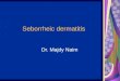 Seborrheic dermatitis Dr. Majdy Naim. Seborrheic dermatitis a papulosquamous disorder patterned on the sebum-rich areas of the scalp, face, and trunk