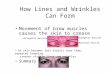 How Lines and Wrinkles Can Form Movement of brow muscles causes the skin to crease Summary corrugator muscles procerus muscle As skin becomes less elastic