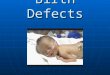 Birth Defects. Cleft Lip/Cleft Palate Can affect anyone Can affect anyone Appears at birth Appears at birth Congenital malformation – Multi-factorial
