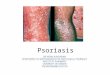 Psoriasis. Definition and facts Epidemiology Classification Signs and symptoms Etiology Diagnosis Management Prognosis 2University of Jordan/Faculty of