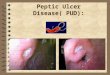 Peptic Ulcer Disease( PUD):. Introduction: 4 Discontinuation of the mucous membrane of the GIT. 4 Acute or chronic; both penetrate the muscularis mucosae