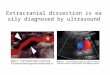 Extracranial dissection is easily diagnosed by ultrasound