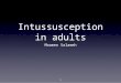 Intussusception in adults Moamen Salameh 1. Intussusception Intussusception of the bowel is defined as the telescoping of a proximal segment of the gastrointestinal