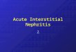 Acute Interstitial Nephritis ?. Etiology A review of three series with a total of 128 patients reported the following distribution of causes of acute