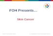 Skin Cancer FOH Presents…. Overview: What is skin cancer What causes skin cancer Types of skin cancer How is skin cancer treated