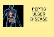 The lesion of peptic ulcer disease (PUD) is a disruption in the mucosal layer of the stomach or duodenum. An ulcer is distinguished from an erosion