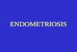 ENDOMETRIOSIS. Endometriosis definition The presence of endometrial tissue in extrauterine locations